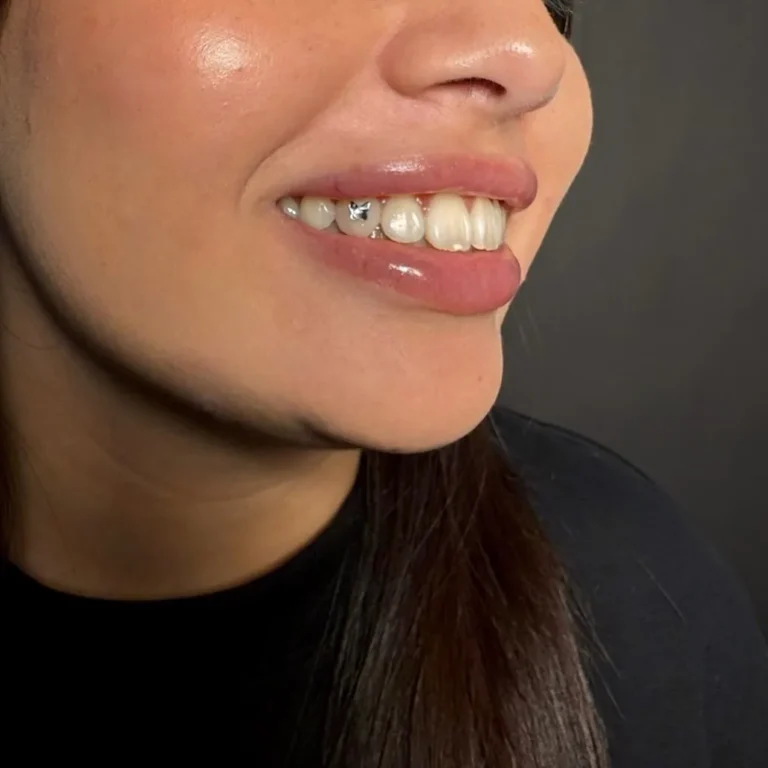 Zilverkleurig vlinderfiguurtje als tooth gem op de tand, zijaanzicht van een glimlach