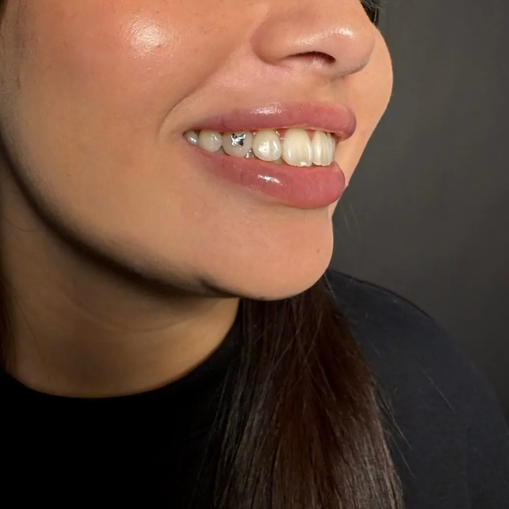 Zilverkleurig vlinderfiguurtje als tooth gem op de tand, zijaanzicht van een glimlach